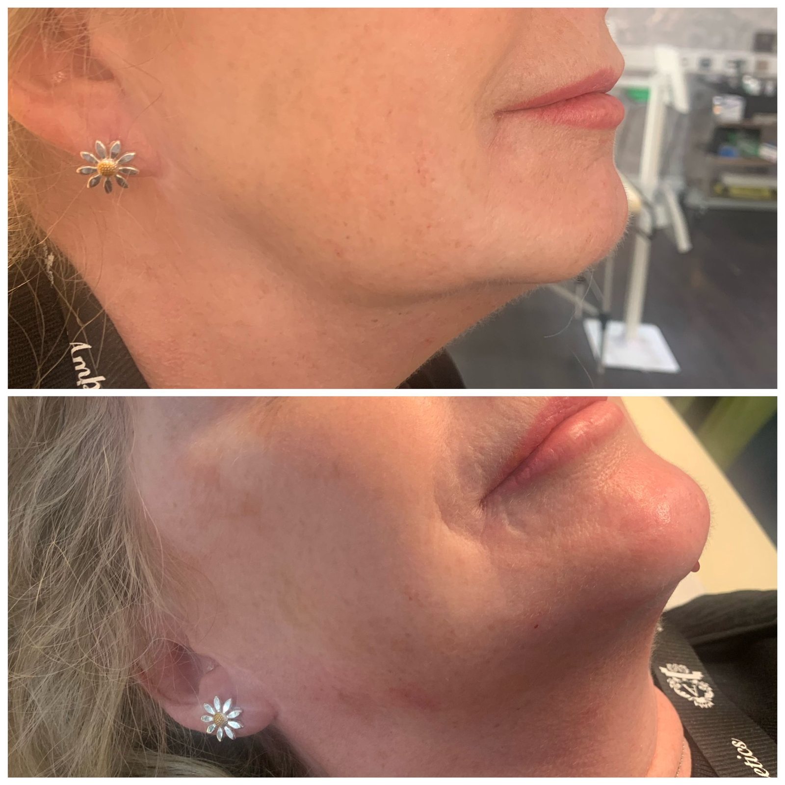 A client’s jawline in profile, before and after treatment