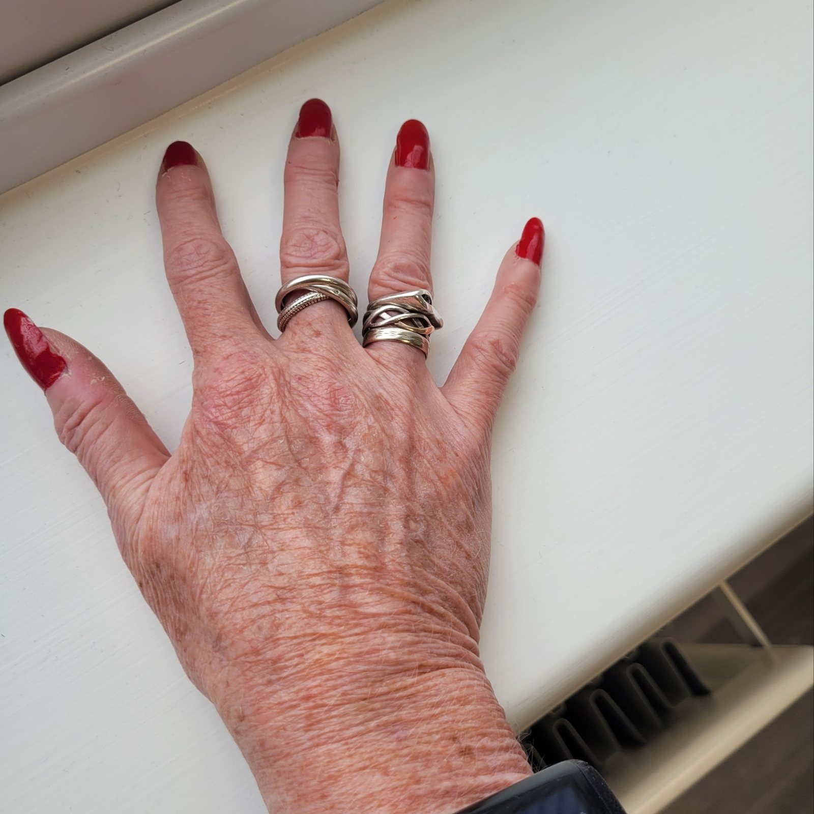 The back of a client’s hand before a skin booster treatment