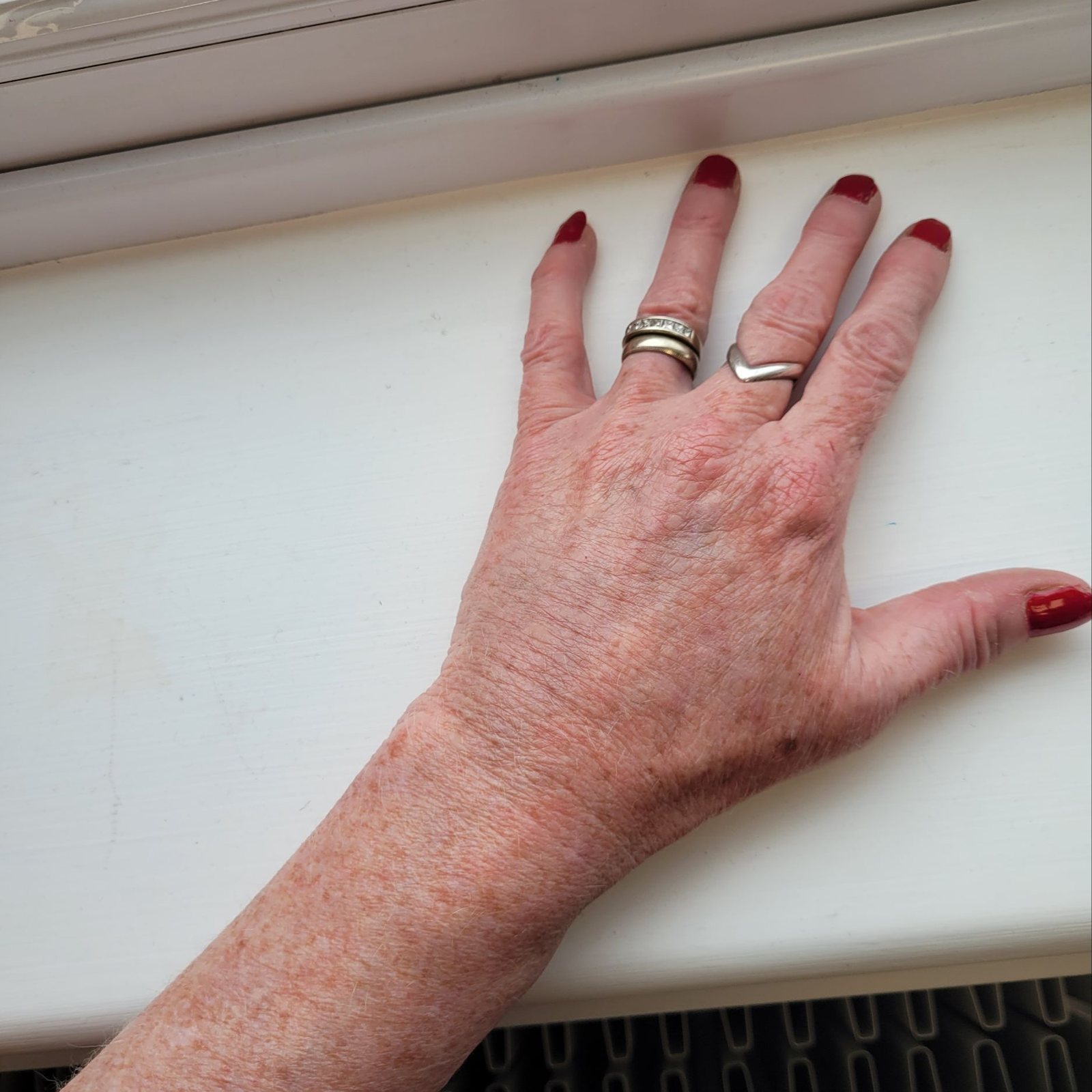 The same hand after a skin booster treatment