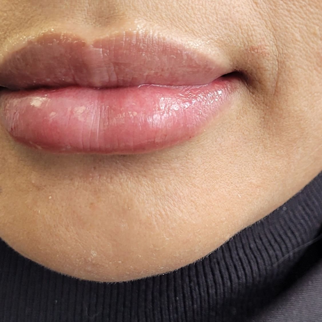 A client’s lips after treatment at Jubilee House